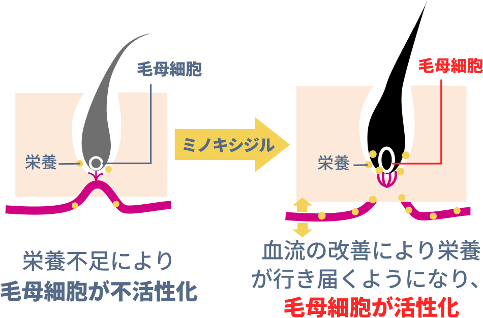 栄養不足により毛母細胞が不活性化 ミノキシジル 血流の改善により栄養が行き届くようになり、毛母細胞が活性化